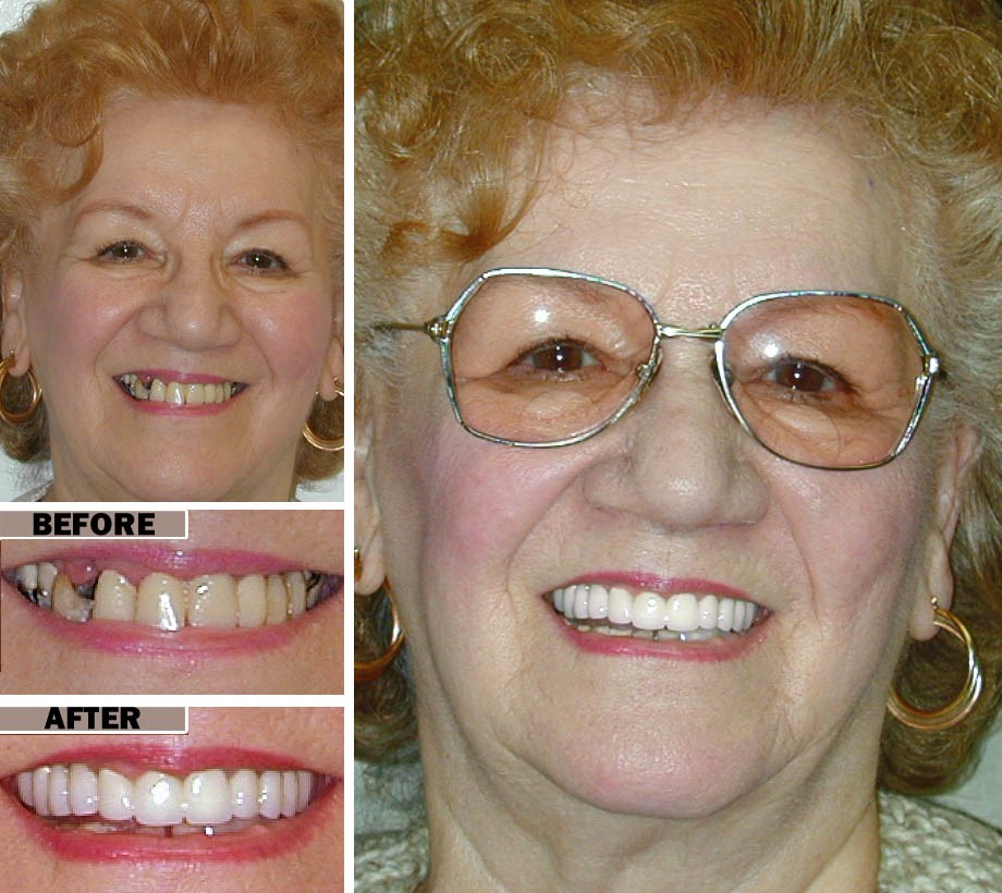 Upper And Lower Partial Dentures Silver Spring MD 20906